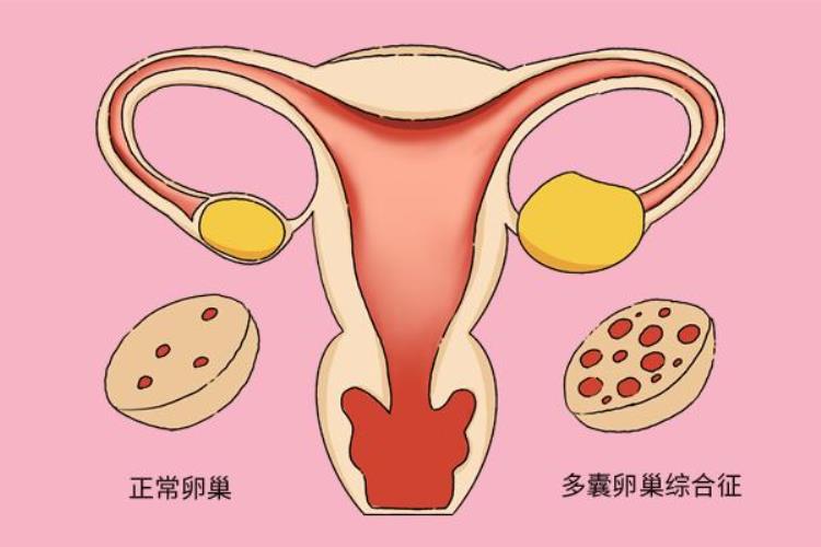 多囊卵巢综合症3年没怀孕「未婚女性会不会得多囊卵巢综合症」