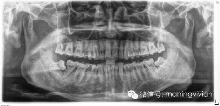 整牙效果如整容备孕期间一定要拔智齿大家最关心的口腔问题答案都在这里了