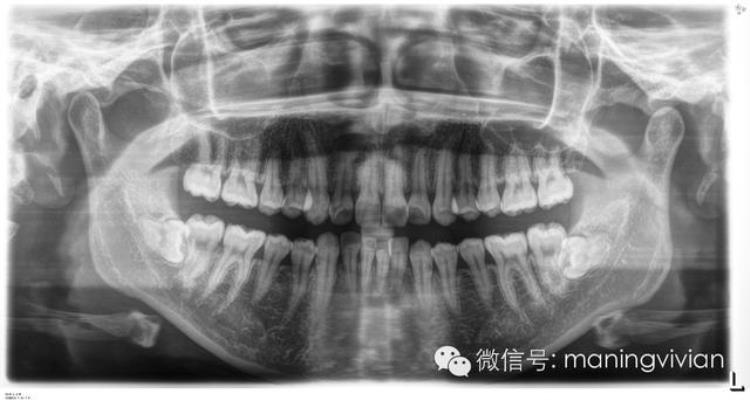 整牙效果如整容备孕期间一定要拔智齿大家最关心的口腔问题答案都在这里了