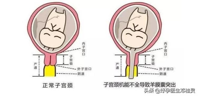 两次大月份羊水破,人工破水跟自己破水有啥区别