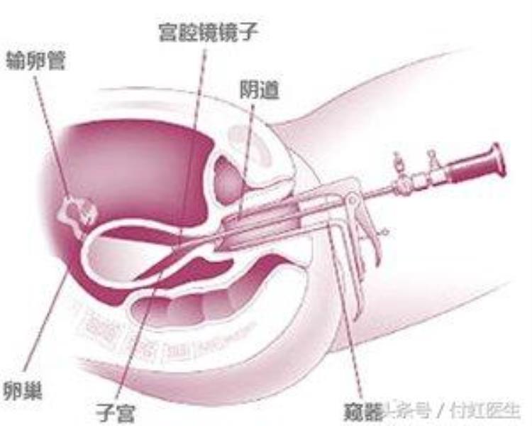 月经紊乱是更年期的表现也要警惕子宫内膜癌嘛,月经一直不停会引发子宫内膜癌吗