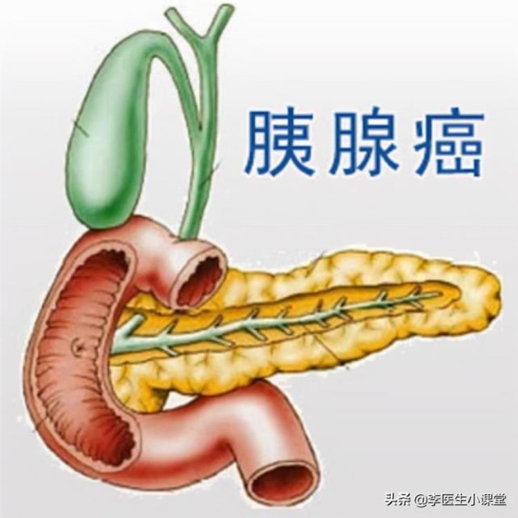 腰痛有肿瘤「女子腰疼3个月一体检就发现体内长了肿瘤医生这得手术了」