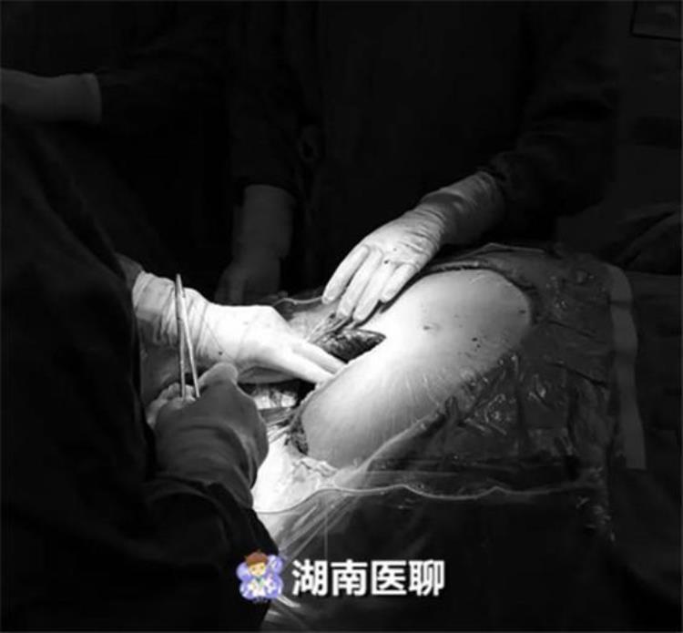 女生怀孕双胞胎以后肚子大了怎么办「女子腹部胀大怀上双胞胎腹痛加剧巧手医生摘除45cm囊肿」