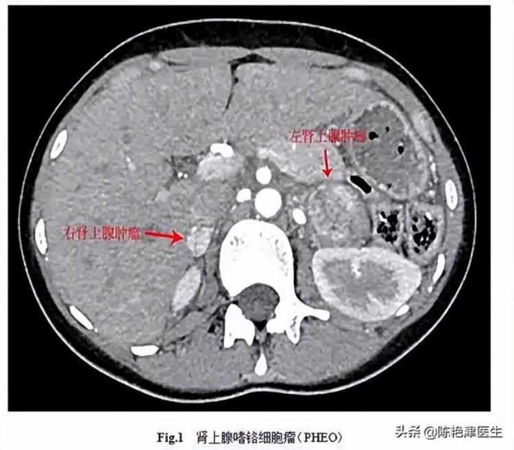 说出汗就出汗是什么毛病「汗液会说话夏天爱出汗或预示4种疾病3个部位汗多要注意」