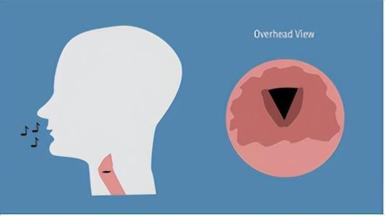 为什么会喉咙沙哑声「掌健识世界嗓音日|为什么喉咙嘶哑」