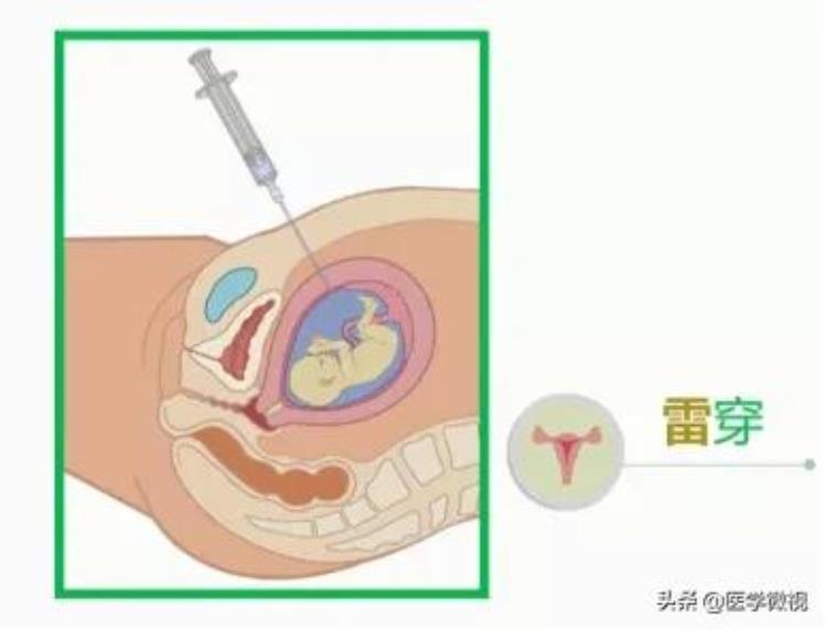 11月份怀孕容易生男孩还是女孩「据说11月可能迎来生娃高峰怀孕后的两种选择你需要了解」