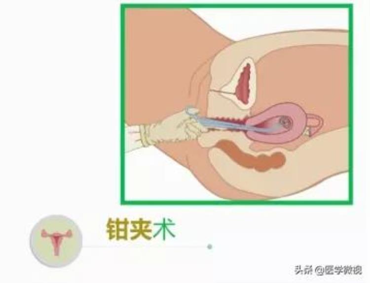 11月份怀孕容易生男孩还是女孩「据说11月可能迎来生娃高峰怀孕后的两种选择你需要了解」