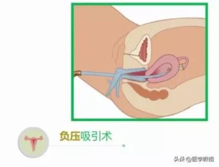 11月份怀孕容易生男孩还是女孩「据说11月可能迎来生娃高峰怀孕后的两种选择你需要了解」