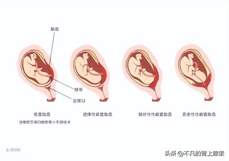 孕期出血的7种主要原因「孕期流血有哪些原因」