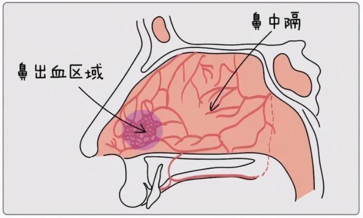 一直流鼻血是因为上火吗「反复流鼻血是上火不5个原因2个方法请收好」