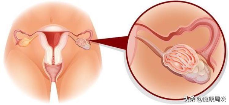 体检 附件囊肿「体检发现附件上长了囊肿是什么情况女性朋友要警惕四种情况」