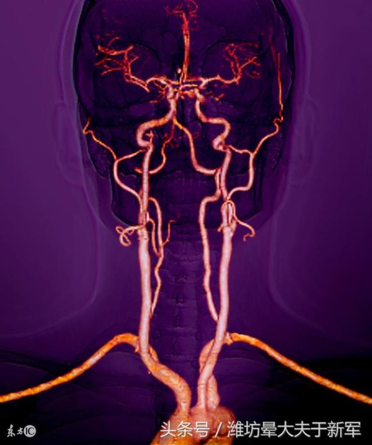 多普勒显示脑供血不足「看过来做经颅多普勒提示脑供血不足是这个原因引起眩晕吗」