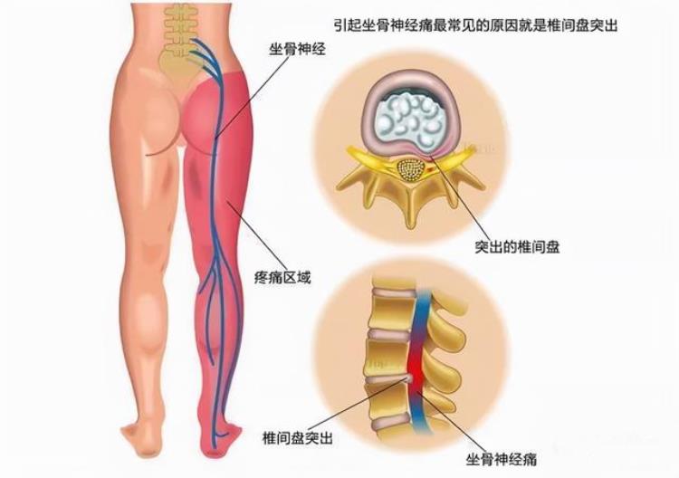 坐骨神经痛为什么总是单侧痛