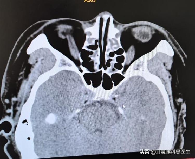 鼻窦炎头疼的规律「鼻窦炎头痛的规律你知道吗」