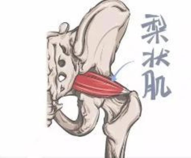 腰疼引发腿麻「腰疼腿麻可不一定是腰脱也许是这块肌肉出问题」