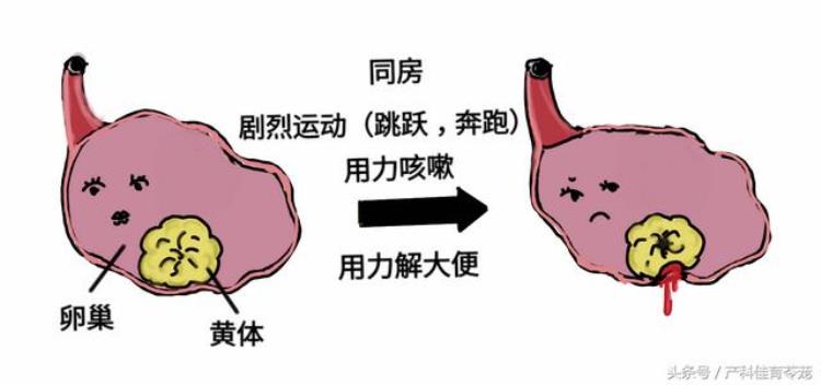 咳嗽之后突发腹痛原来是卵巢黄体破了