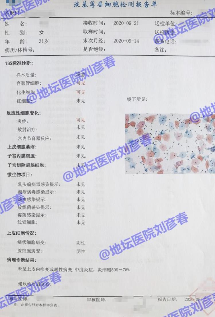 病例分享TCT检测显示中度炎症怎么办需要治疗吗