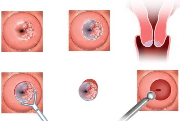 hpv病毒检测首选这种简单有效在家即可取样的方法是,hpv病毒自测方法