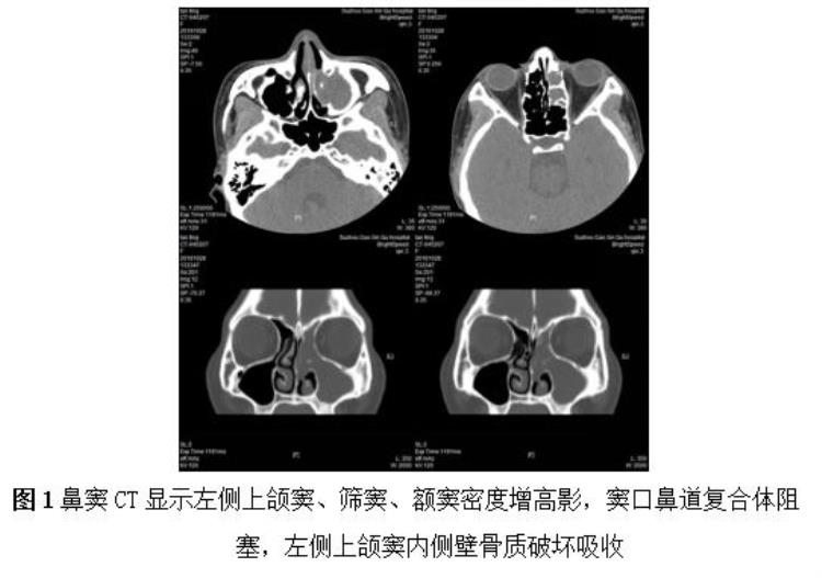 长期单侧鼻塞流涕需警惕这个病症吗,老是晚上鼻塞流涕是怎么回事