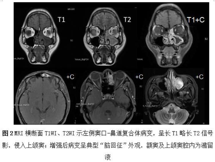 长期单侧鼻塞流涕需警惕这个病症吗,老是晚上鼻塞流涕是怎么回事