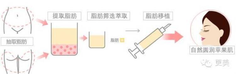 打苹果肌是什么意思啊「打苹果肌是个技术活」