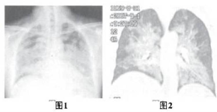 胸片蝴蝶征「胸部典型征象丨蝶翼征」