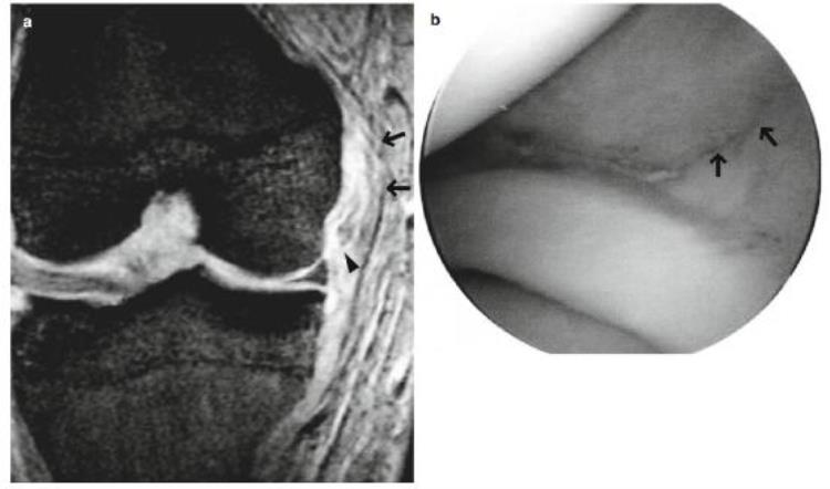 内侧副韧带断裂mri「自信诊断内侧副韧带MCL撕裂」