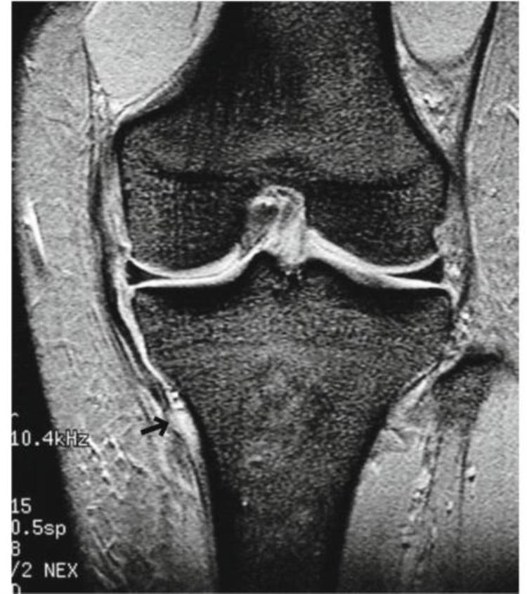 内侧副韧带断裂mri「自信诊断内侧副韧带MCL撕裂」