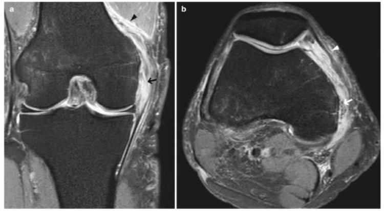 内侧副韧带断裂mri「自信诊断内侧副韧带MCL撕裂」