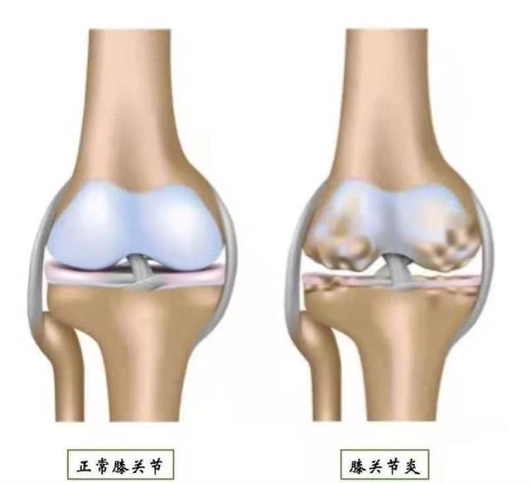关节炎预测天气「关节炎真的能预报天气吗膝盖一疼就要变天」
