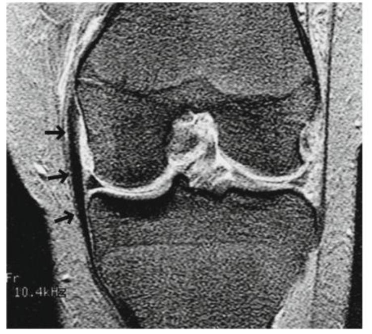 内侧副韧带断裂mri「自信诊断内侧副韧带MCL撕裂」