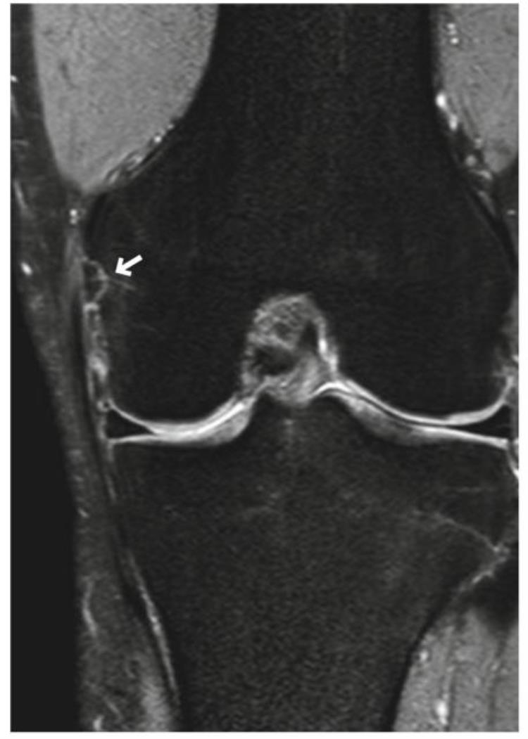 内侧副韧带断裂mri「自信诊断内侧副韧带MCL撕裂」