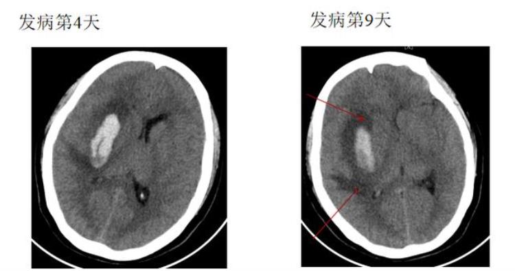 脑出血周围水肿原因「脑出血周围水肿是怎么回事这是我听到最好的解释」