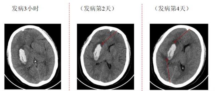 脑出血周围水肿原因「脑出血周围水肿是怎么回事这是我听到最好的解释」