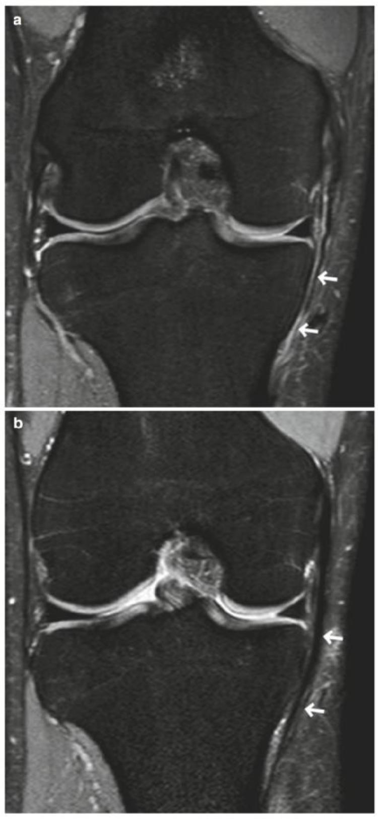 内侧副韧带断裂mri「自信诊断内侧副韧带MCL撕裂」