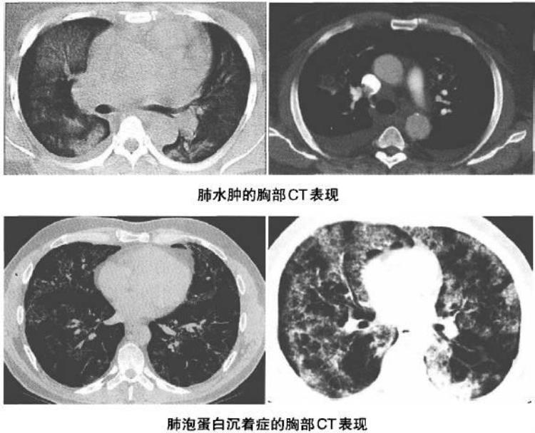 胸片蝴蝶征「胸部典型征象丨蝶翼征」