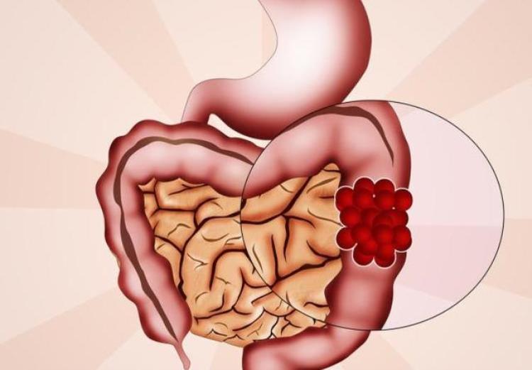 消化道肿瘤临床表现有哪些「消化道脂肪瘤发生病变较为少见临床表现不典型手术治疗较普遍」