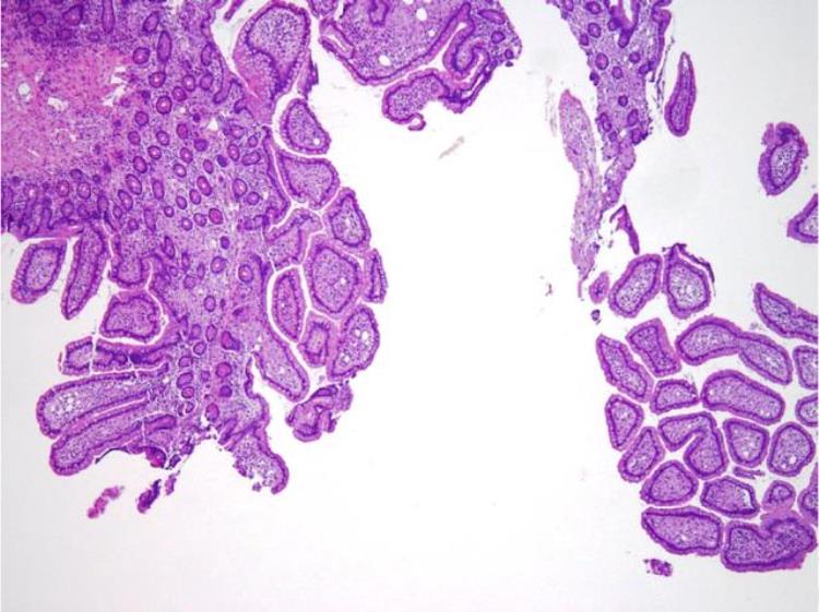 水状腹泻发烧「水样腹泻3个月伴发烧这个病值得引起注意|病例学习」