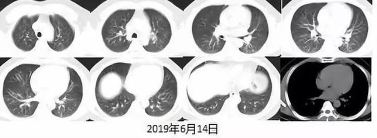 肺水肿是什么病?「一文读懂肺水肿你get了吗」