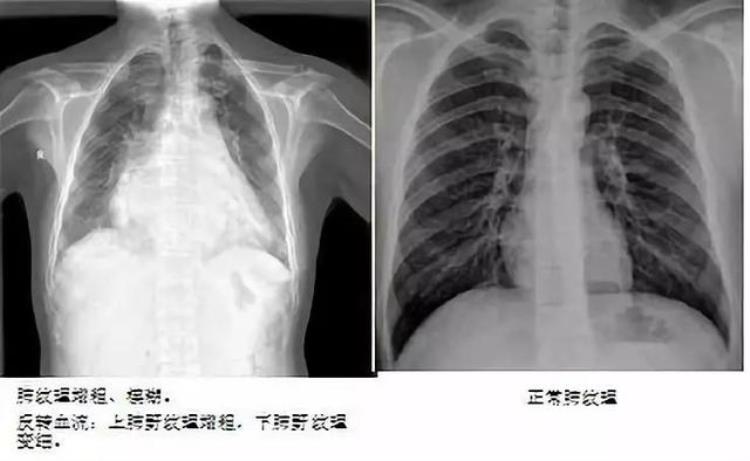 肺水肿是什么病?「一文读懂肺水肿你get了吗」