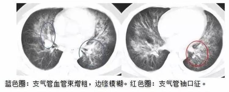 肺水肿是什么病?「一文读懂肺水肿你get了吗」