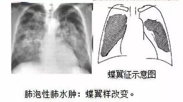 肺水肿是什么病?「一文读懂肺水肿你get了吗」