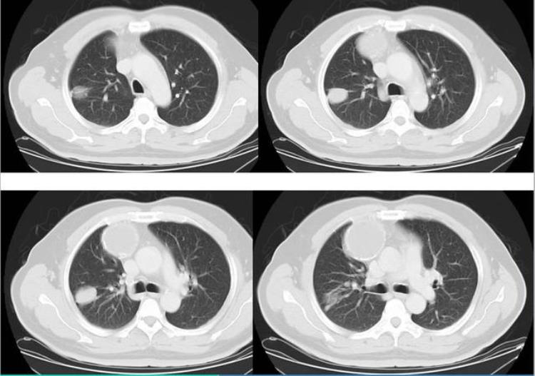 消化道肿瘤临床表现有哪些「消化道脂肪瘤发生病变较为少见临床表现不典型手术治疗较普遍」