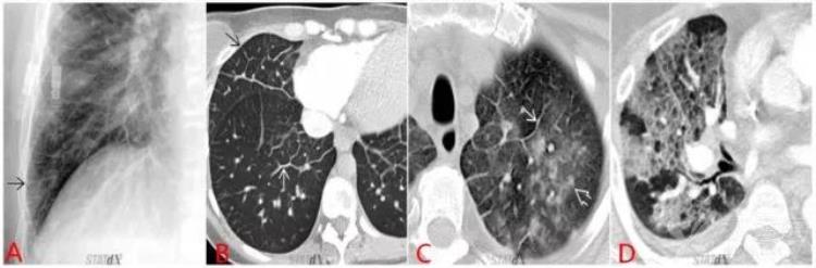让无数医生犯难的肺水肿诊断其实就看这两点是什么病「让无数医生犯难的肺水肿诊断其实就看这两点」