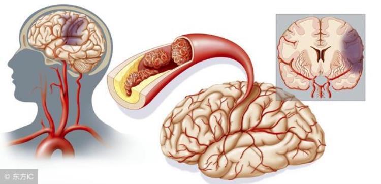 脑梗能不能治愈(脑梗能治愈么能活多久)