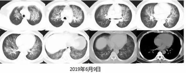 肺水肿是什么病?「一文读懂肺水肿你get了吗」