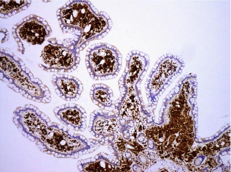 水状腹泻发烧「水样腹泻3个月伴发烧这个病值得引起注意|病例学习」