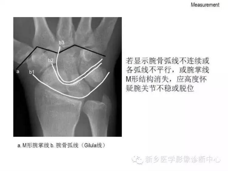 腕关节x线报告模板「详细的腕关节X线解剖摄影技巧阅片技巧测量」