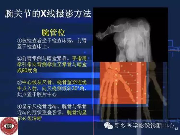 腕关节x线报告模板「详细的腕关节X线解剖摄影技巧阅片技巧测量」