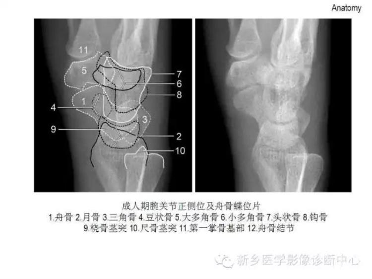 腕关节x线报告模板「详细的腕关节X线解剖摄影技巧阅片技巧测量」